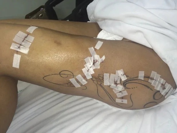 Andressa Urach teve complicações com o uso de hidrogel